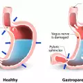 Как гастропарезата парализира стомаха ви?