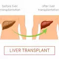 Какво трябва да знаете за трансплантацията на черен дроб?