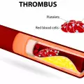 Тромби – причини, симптоми и предпазване