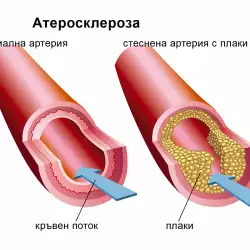 Как да се предпазим от атеросклероза