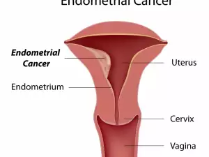 Рак на ендометриума