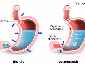 Как гастропарезата парализира стомаха ви?