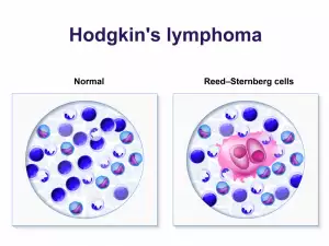 Болест на Ходжкин