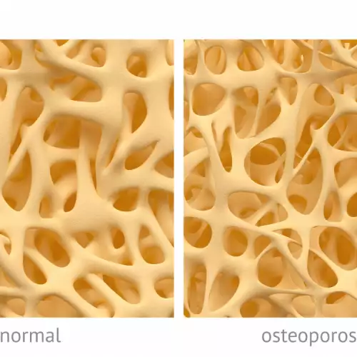 Остеопороза - защо се получава и как да се предпазим?