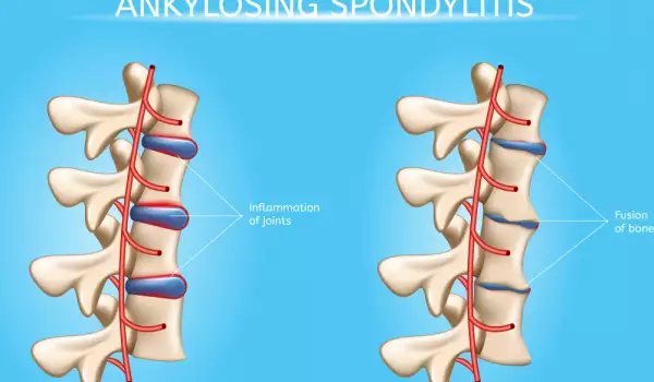 Артрит на гръбначния стълб