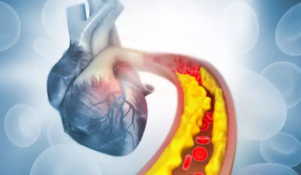 Рискове при коронарна съдова болест