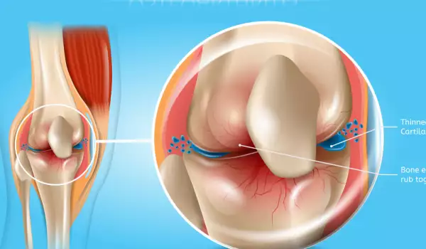 Как да облекчим болката в коленете при артрит?