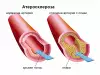 Как да се предпазим от атеросклероза